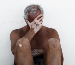 /vitiligo/bdfby/7520.html