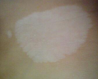  /vitiligo/bdfcs/7535.html