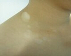  /vitiligo/bdfcs/7536.html