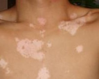  /vitiligo/bdfsl/7432.html