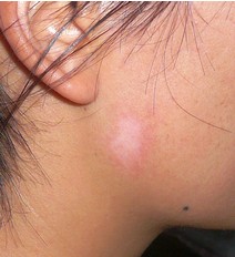 /vitiligo/bdfxl/7444.html