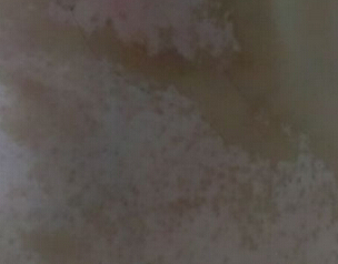 /vitiligo/bdfzd/7530.html