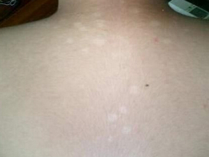  /vitiligo/bdfzg/7511.html